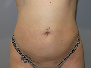 Liposuction Before and After | Grover Aesthetics
