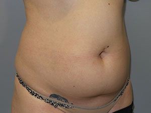 Liposuction Before and After 62 | Grover Aesthetics
