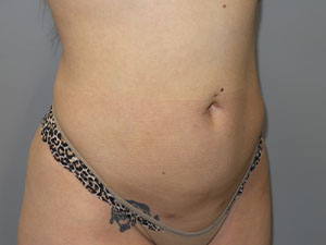 Liposuction Before and After 62 | Grover Aesthetics