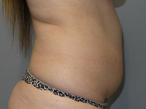 Liposuction Before and After 62 | Grover Aesthetics