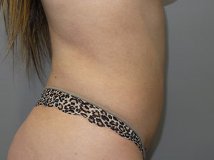 Liposuction Before and After 62 | Grover Aesthetics