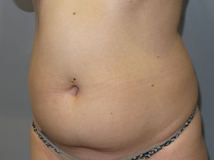 Liposuction Before and After 62 | Grover Aesthetics