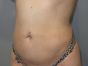 Liposuction Before and After 62 | Grover Aesthetics