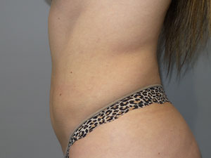 Liposuction Before and After 62 | Grover Aesthetics