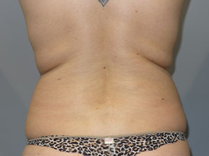 Liposuction Before and After 62 | Grover Aesthetics
