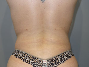 Liposuction Before and After 62 | Grover Aesthetics