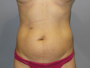 Liposuction Before and After 17 | Sanjay Grover MD FACS