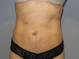 Liposuction Before and After | Grover Aesthetics