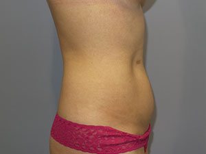 Liposuction Before and After 63 | Grover Aesthetics