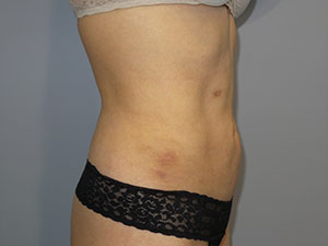 Liposuction Before and After 63 | Grover Aesthetics