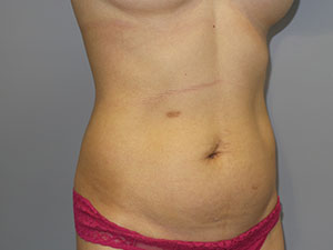 Liposuction Before and After 63 | Grover Aesthetics