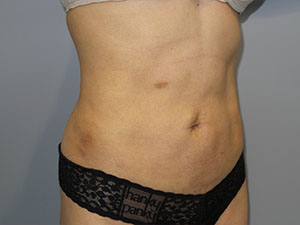 Liposuction Before and After 63 | Sanjay Grover MD FACS
