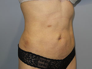 Liposuction Before and After 63 | Grover Aesthetics