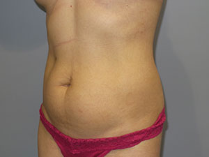 Liposuction Before and After 63 | Grover Aesthetics