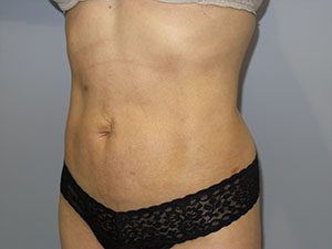 Liposuction Before and After 63 | Sanjay Grover MD FACS