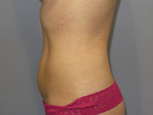 Liposuction Before and After 63 | Grover Aesthetics