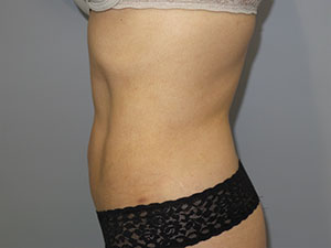 Liposuction Before and After 63 | Grover Aesthetics