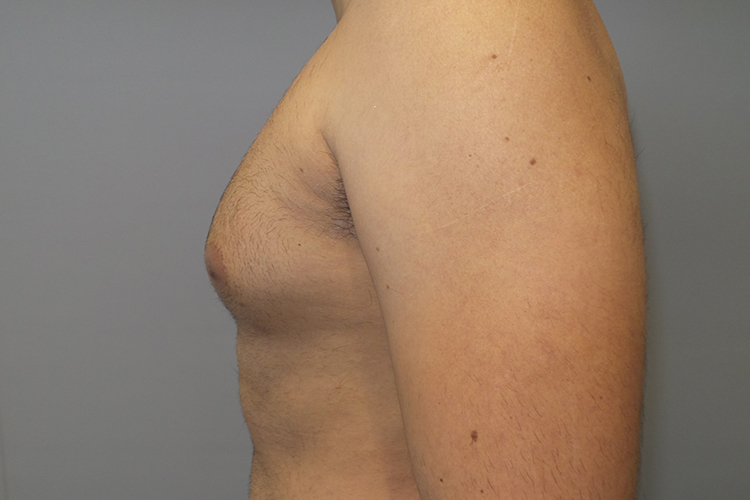 Liposuction Before and After 64 | Sanjay Grover MD FACS