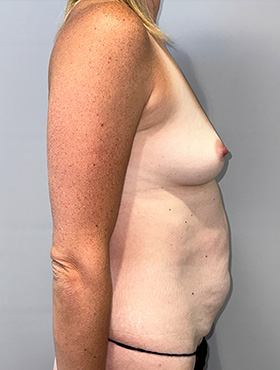 Mommy Makeover Before and After 01 | Grover Aesthetics