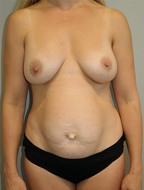Mommy Makeover Before and After | Grover Aesthetics