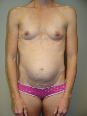 Mommy Makeover Before and After | Grover Aesthetics