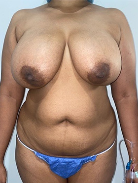 Mommy Makeover Before and After | Grover Aesthetics