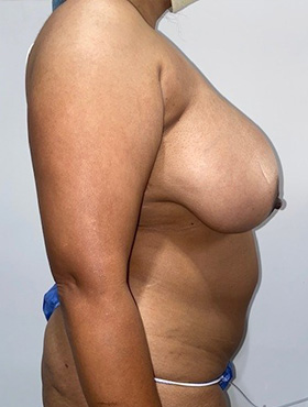Mommy Makeover Before and After 07 | Grover Aesthetics