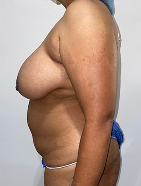 Mommy Makeover Before and After 07 | Grover Aesthetics