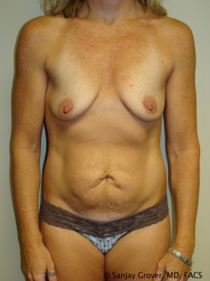 Mommy Makeover Before and After | Grover Aesthetics