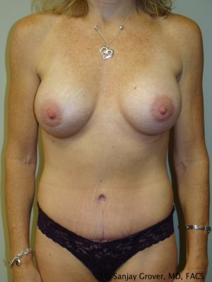 Mommy Makeover Before and After | Grover Aesthetics