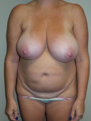 Mommy Makeover Before and After | Grover Aesthetics