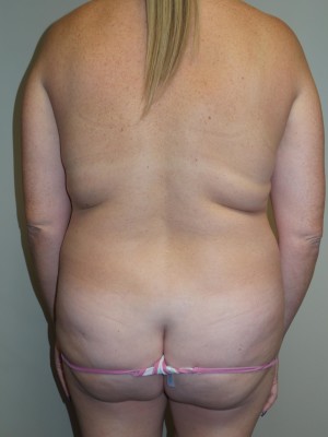 Mommy Makeover Before and After 11 | Grover Aesthetics