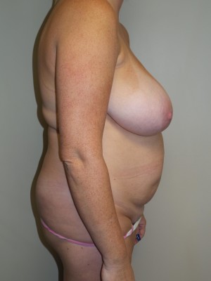 Mommy Makeover Before and After 11 | Grover Aesthetics