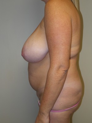 Mommy Makeover Before and After 11 | Grover Aesthetics