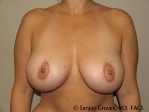 Mommy Makeover Before and After | Grover Aesthetics