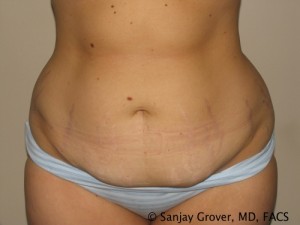 Mommy Makeover Before and After 13 | Grover Aesthetics
