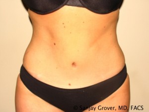 Mommy Makeover Before and After 13 | Grover Aesthetics