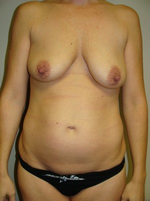 Mommy Makeover Before and After | Grover Aesthetics