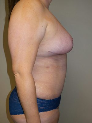 Mommy Makeover Before and After 15 | Grover Aesthetics