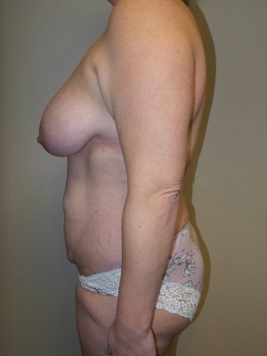 Mommy Makeover Before and After 15 | Grover Aesthetics
