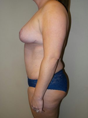 Mommy Makeover Before and After 15 | Grover Aesthetics