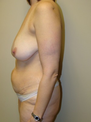 Mommy Makeover Before and After 16 | Grover Aesthetics