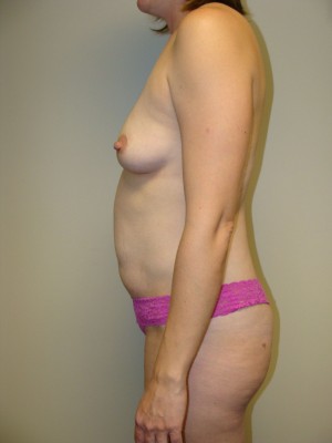 Mommy Makeover Before and After 18 | Grover Aesthetics