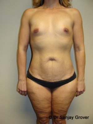 Mommy Makeover Before and After | Grover Aesthetics