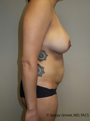 Mommy Makeover Before and After 23 | Grover Aesthetics