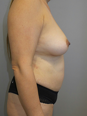 Mommy Makeover Before and After 25 | Grover Aesthetics
