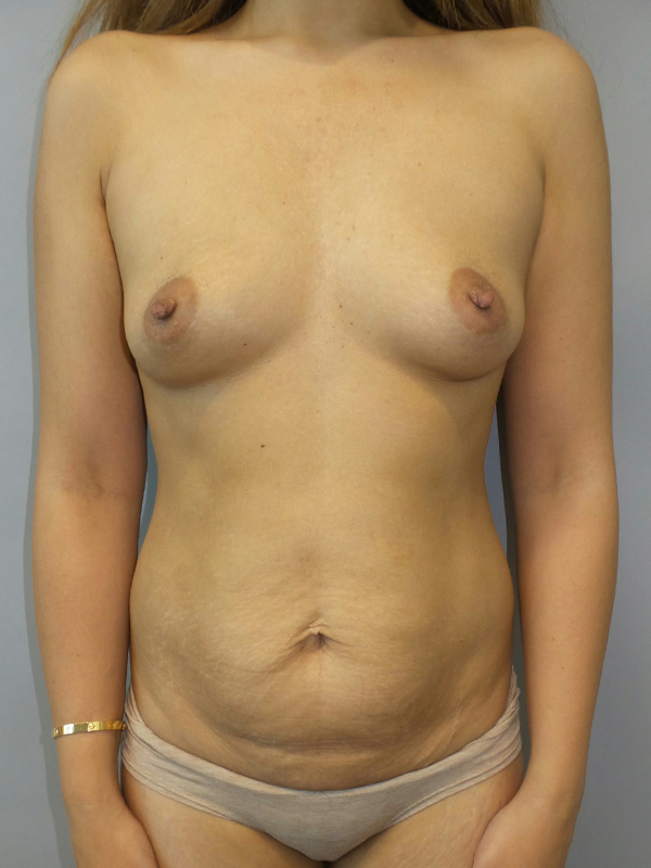 Mommy Makeover Before and After | Grover Aesthetics