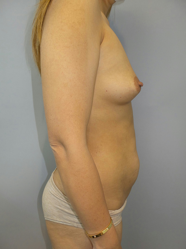 Mommy Makeover Before and After 27 | Grover Aesthetics