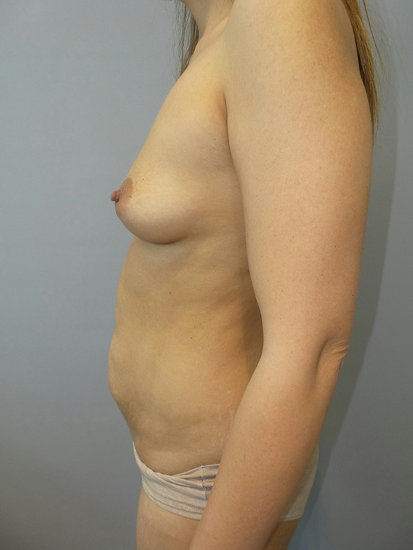 Mommy Makeover Before and After 27 | Grover Aesthetics