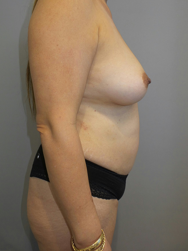 Mommy Makeover Before and After 28 | Grover Aesthetics